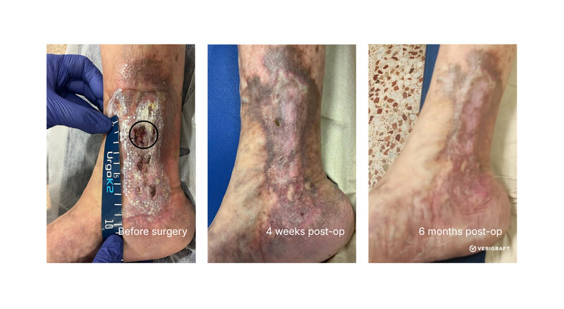 Restorative effect of replacing diseased vein with fully biological P-TEV personalized tissue engineered vein