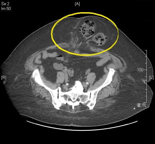 《圖說》黃崧峰醫師說明，電腦斷層影像顯示腹部手術傷口處出現疝氣，導致腸道突出(黃圈處），增加手術難度及病患術後恢復的天數。〈土城醫院提供〉